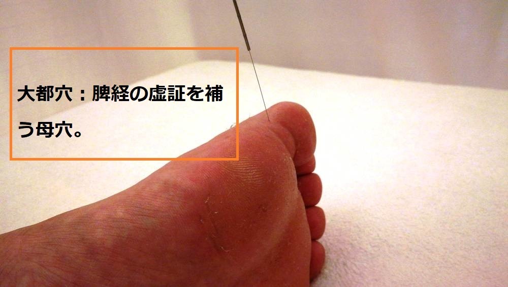 足の親指の裏が痛いのは、鍼治療1回で治った
