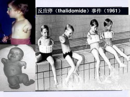 たくさんの畸形児を作り出したサリドマイド薬害事件