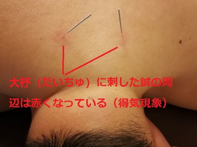 大杼（だいちゅ、骨会）に刺した鍼の画像