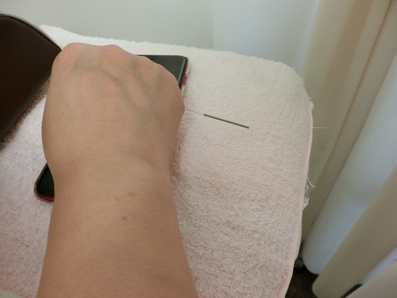 右の後谿に刺した鍼。