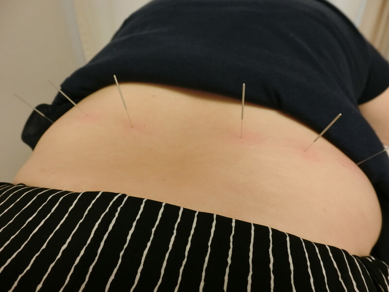 腰の腎兪、志室、京門に刺した鍼。