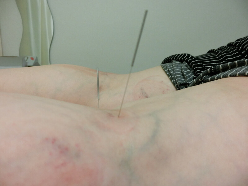 陰谷、委中でほとんどの腰痛が治る