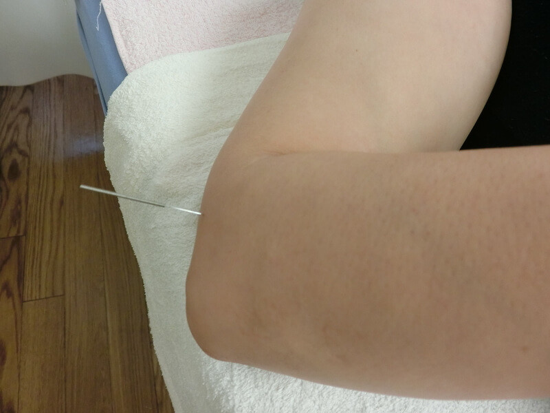 右の曲池に刺した鍼。