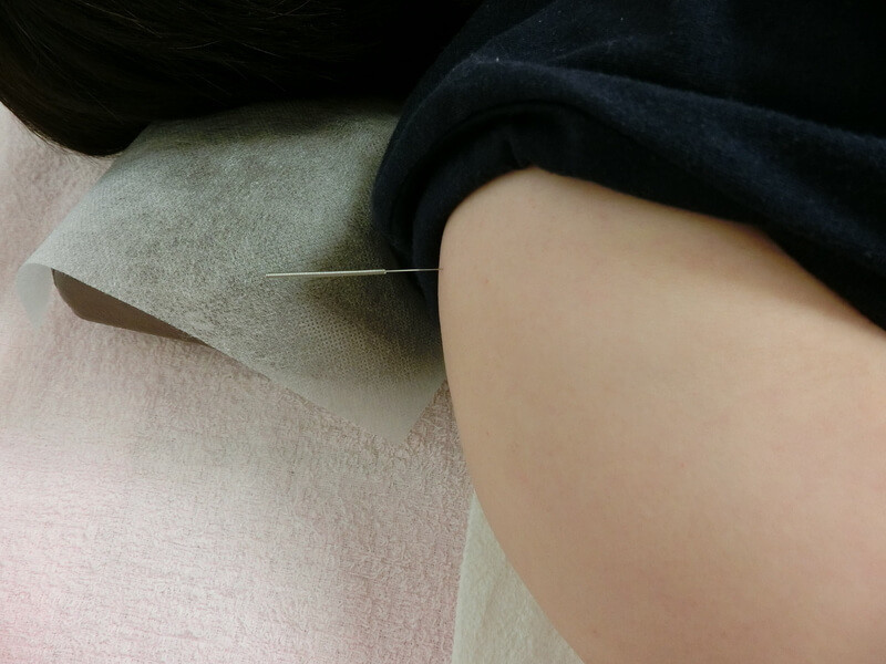 右の肩髃（けんぐ）に刺した鍼。