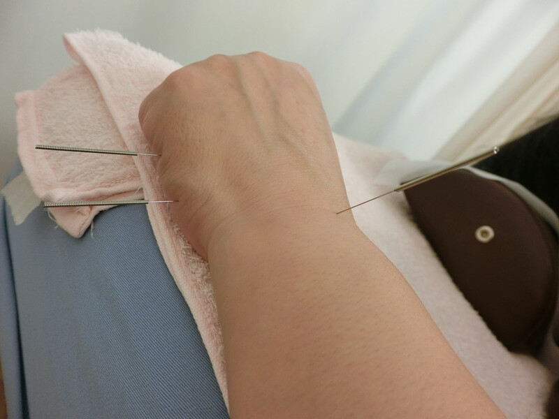 左の腕順１と２（董氏奇穴）。左手首の圧痛点に刺した鍼。
