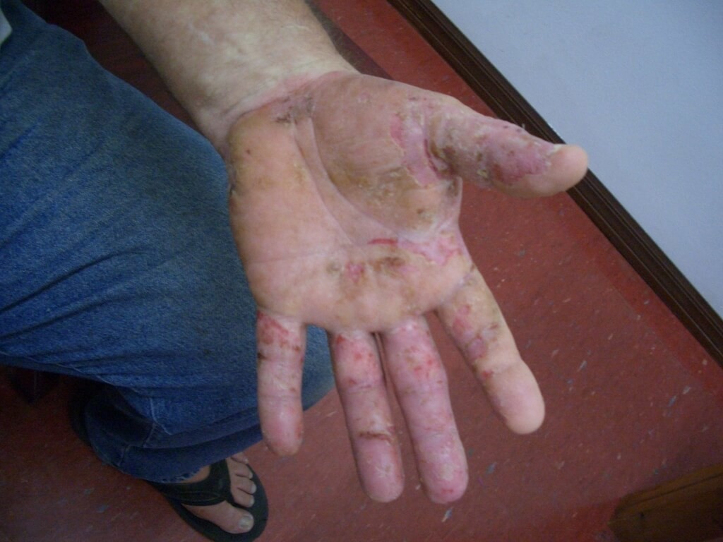 手のひらが爛れて痒いのは鍼と漢方薬で著しく改善