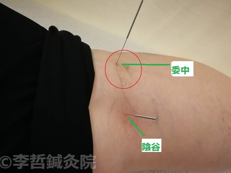 腰痛を治すツボ、委中と陰谷に刺した鍼