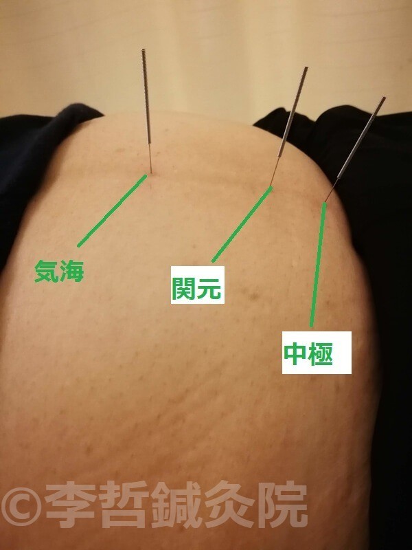 気海、関元、中極に刺した鍼。体内を温めるツボセット。