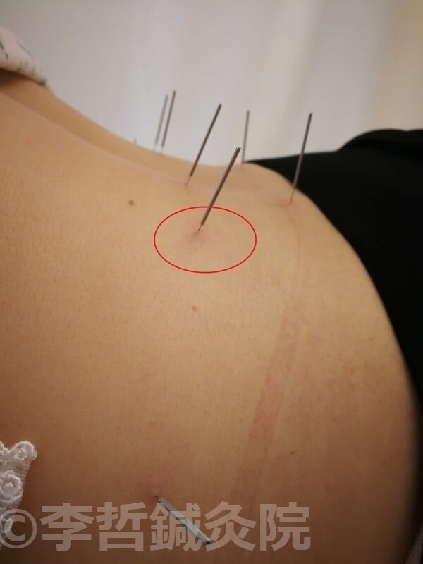 押して一番痛がったところは志室穴（赤い丸）