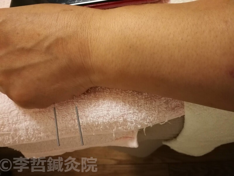 董氏奇穴の腕順１と腕順２。腰痛・膝の痛みにも有効