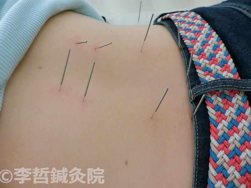 腎兪、大腸兪、脾兪、胃兪、京門に刺した鍼。