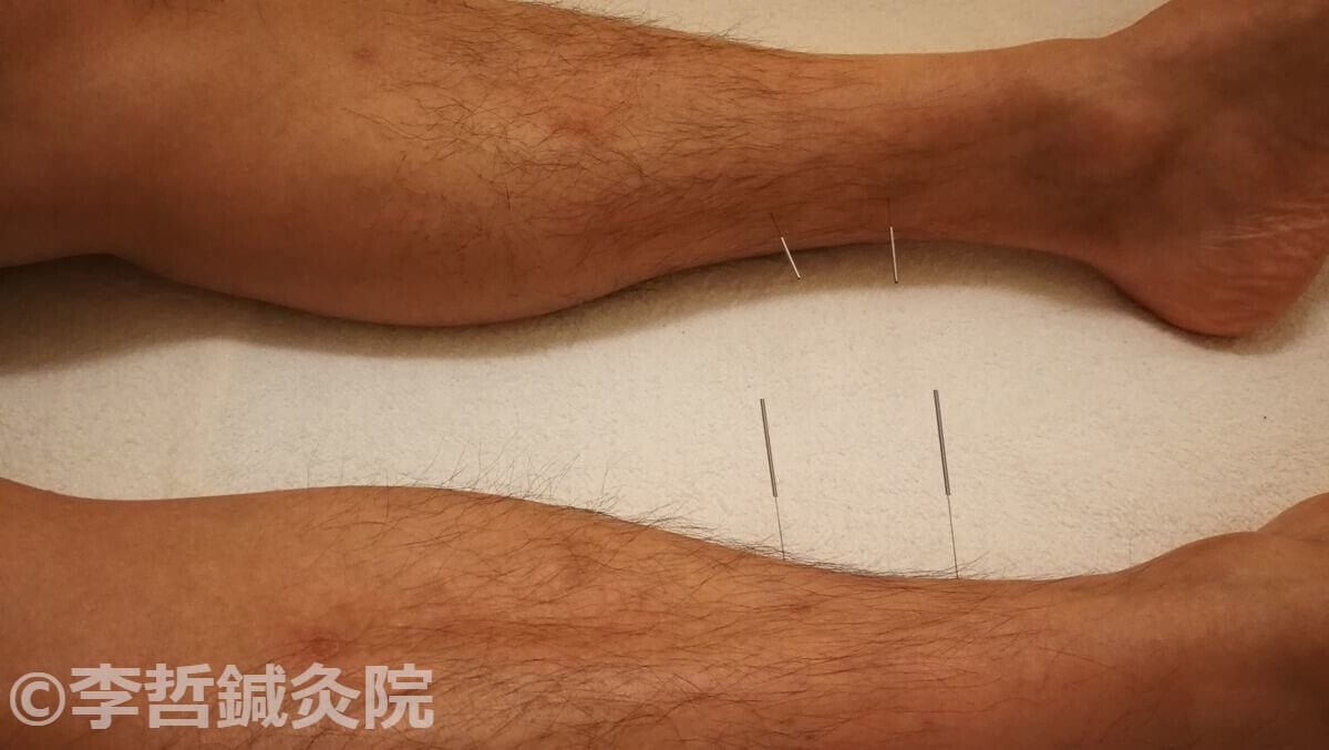 赤い発疹は鍼治療後ほとんど肌色になった