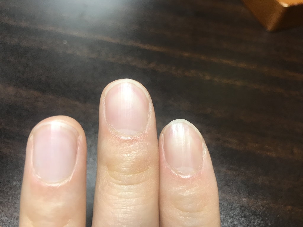 手の皮がむける 手の乾燥の救世主 これで全部解決した 人生充実ブログ