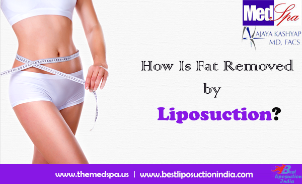f:id:liposuctionindelhi:20170830154515p:plain