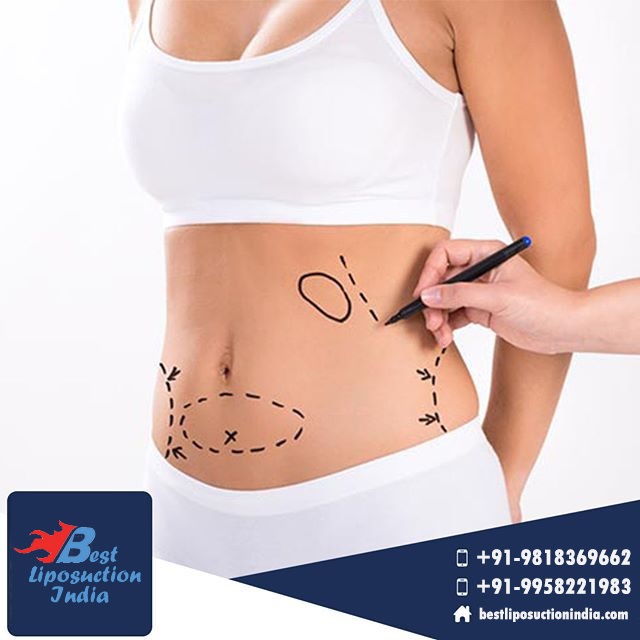 f:id:liposuctionindelhi:20180320132544j:plain