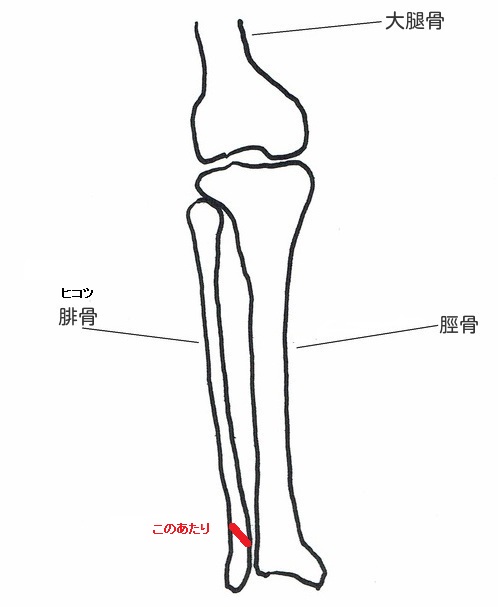 腓骨骨折 ２ 体験記 若気の至りで申し訳ありません と骨折を治すコツ トクする 栄太郎のブログ