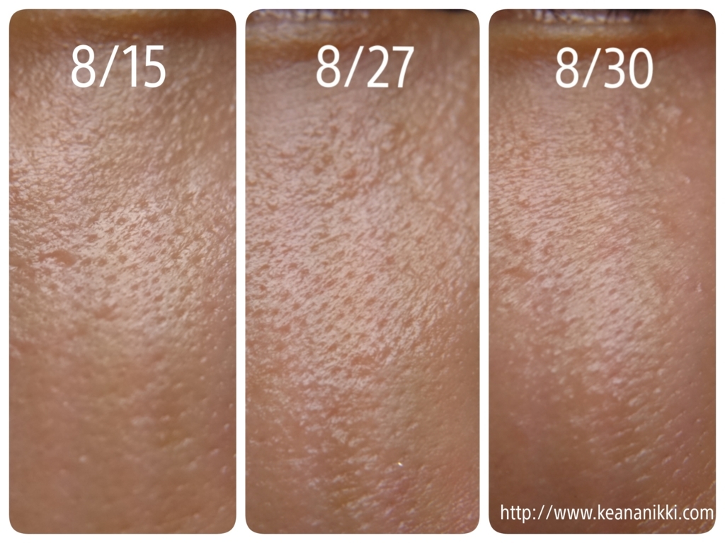 頬 毛穴 脱毛 Krob