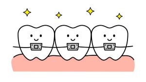 歯にブラケットとワイヤーを装着しているイラスト