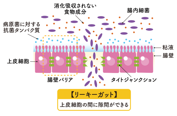 リーキーガット症候群の説明イラスト