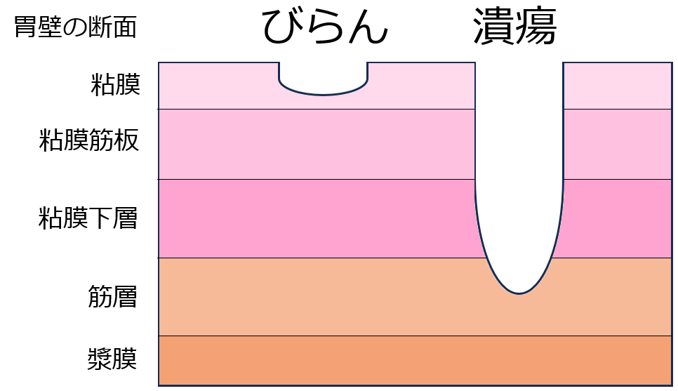 Q びらんと潰瘍(かいよう)はどちらが傷が深いでしょうか？ - 正直薬剤師のクイズで学ぶ臨床薬学