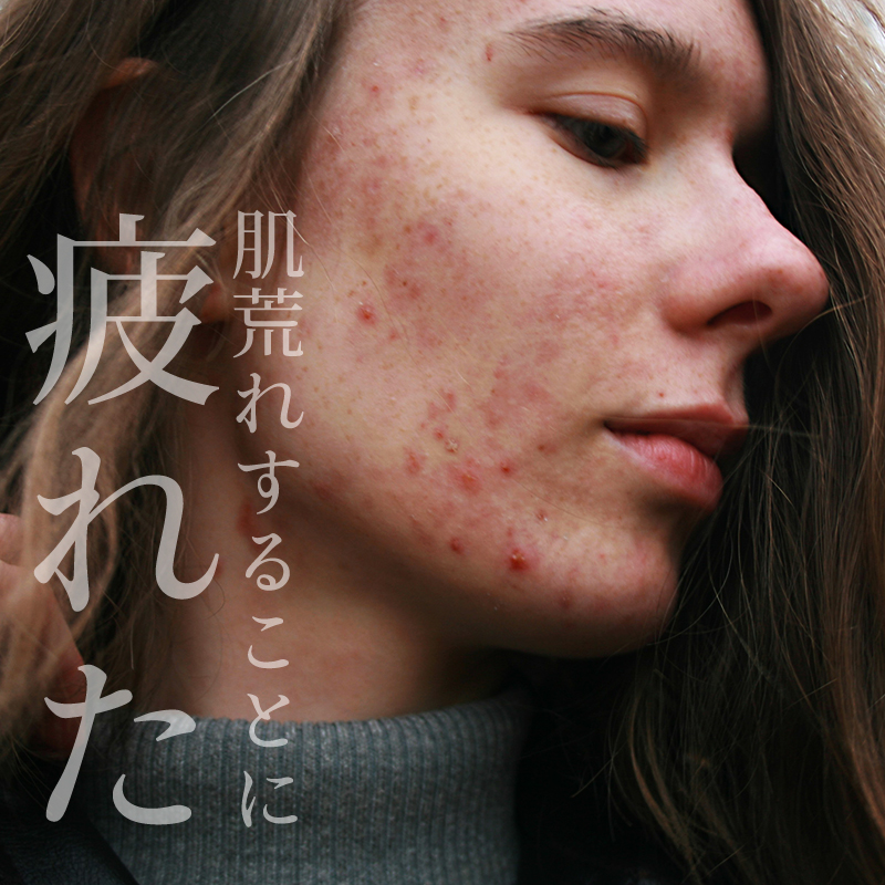 特に肌荒れ中に、化粧水や美容液など「つけるもの」を次々に試していたら、ちょっと注意が必要。