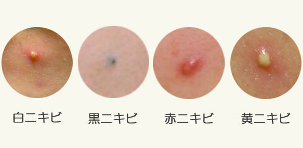 なかなか治らないニキビの治療法