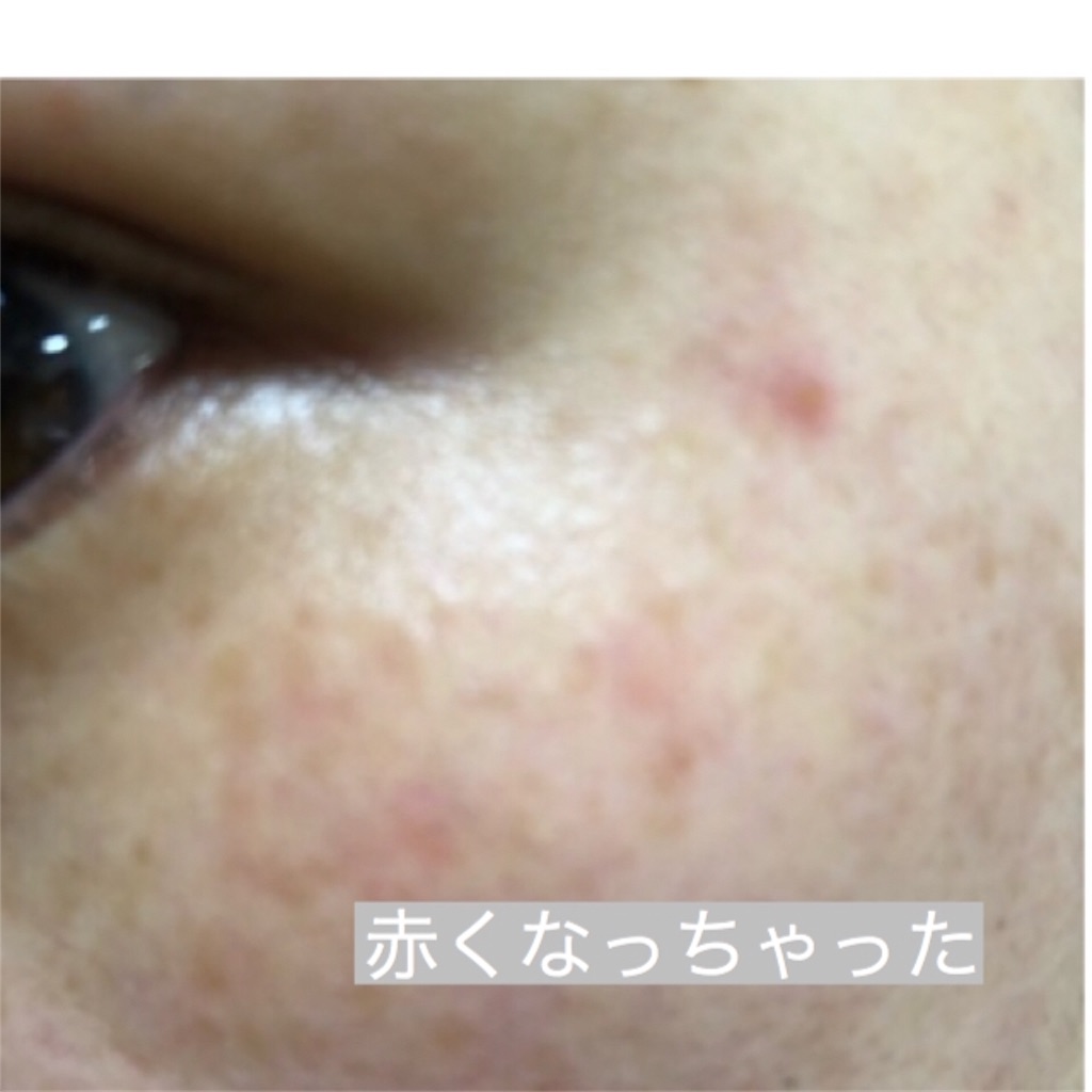 肌荒れ 32歳