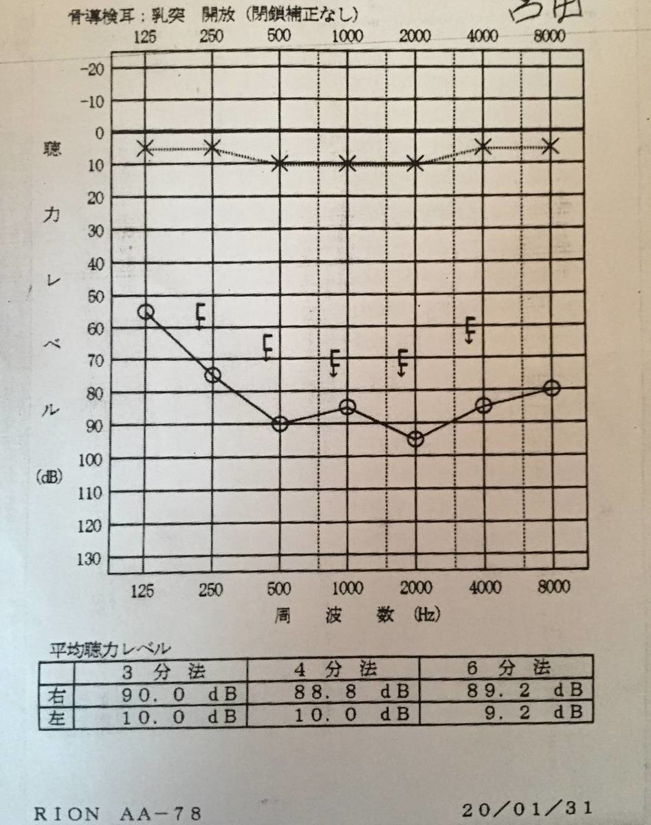 入院直後の聴力検査の結果