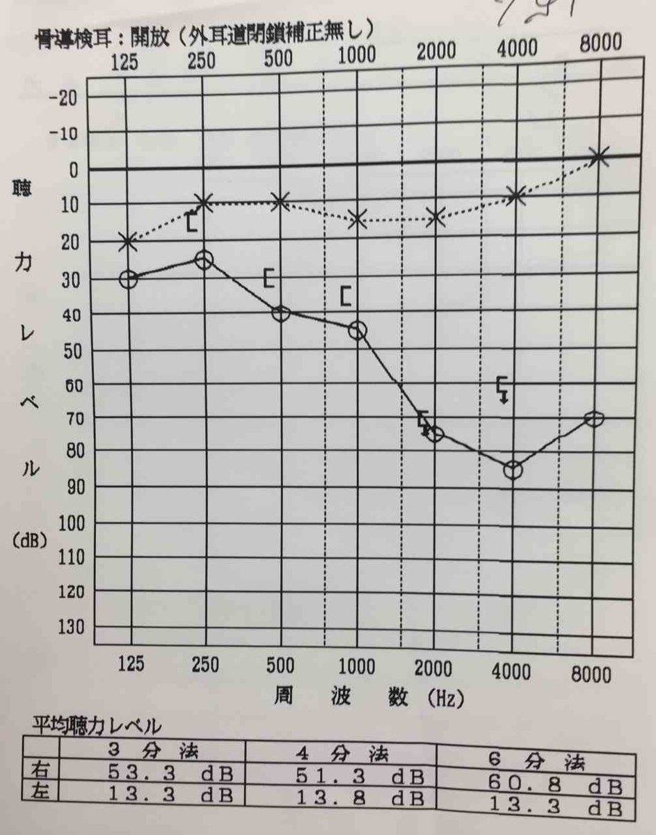 発症から約1ヵ月後の聴力検査の結果