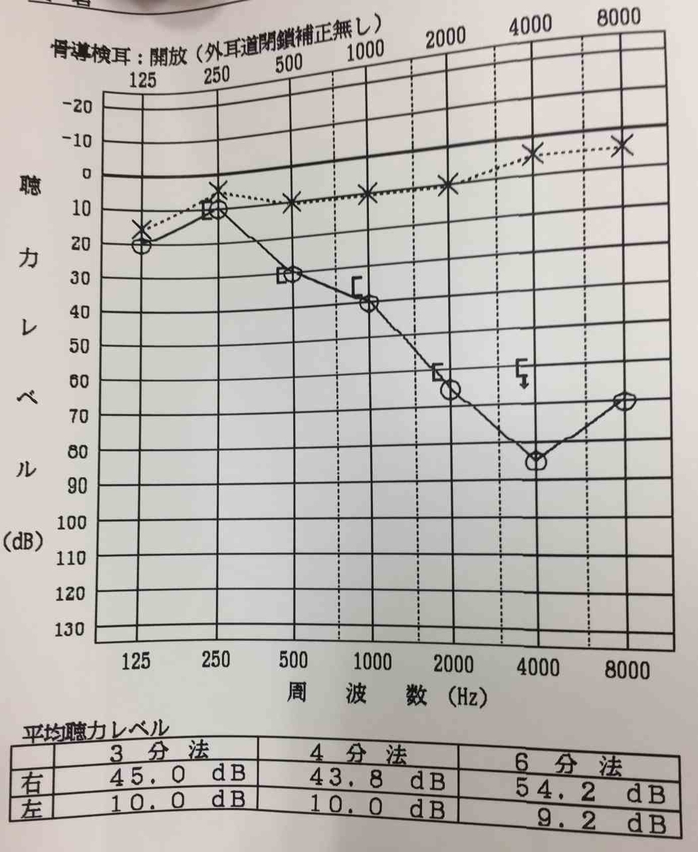 発症後2カ月の聴力検査結果