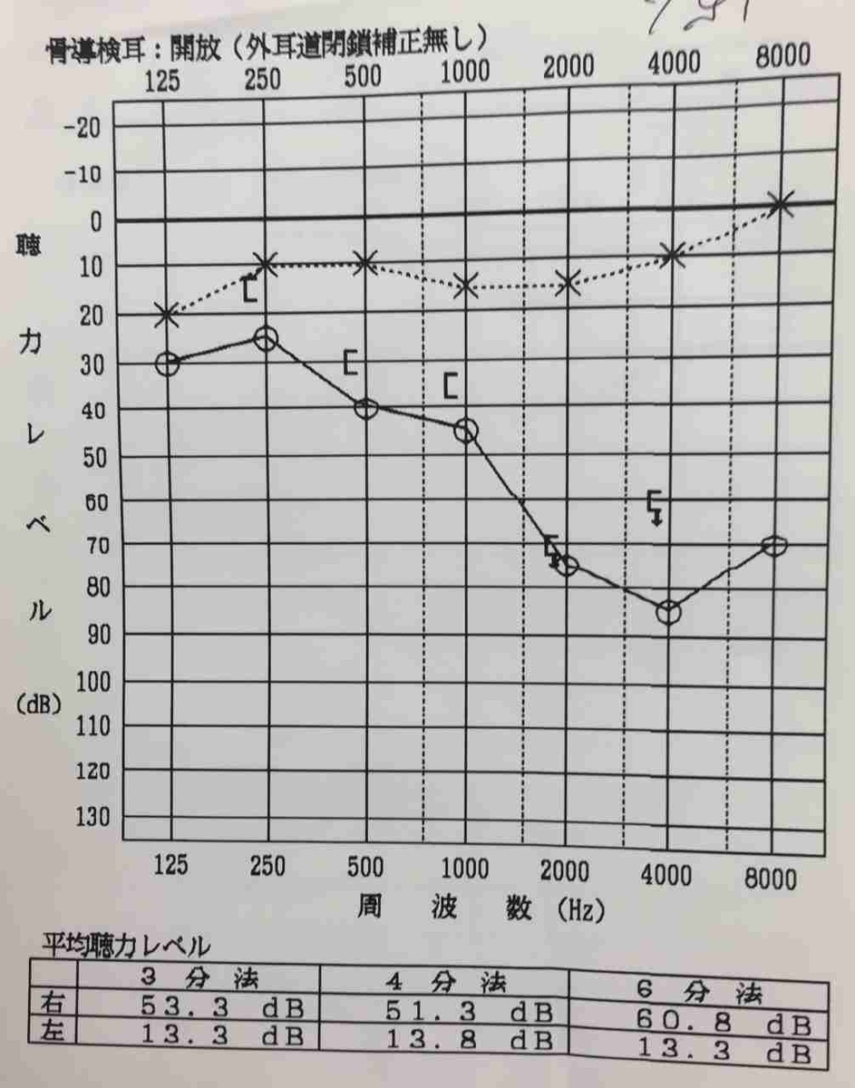 発症後23日の聴力検査の結果