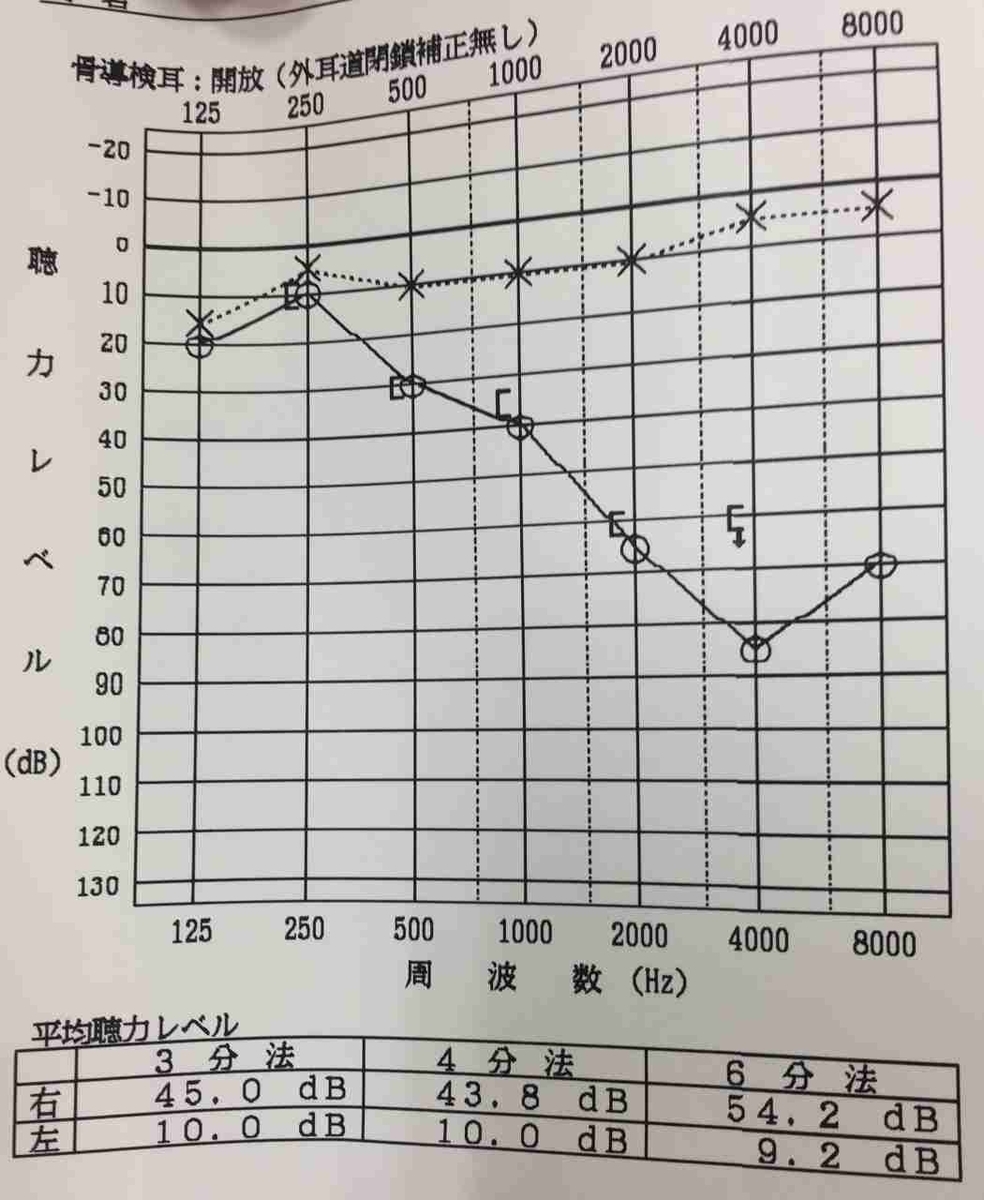 突発性難聴66日後の聴力検査の結果
