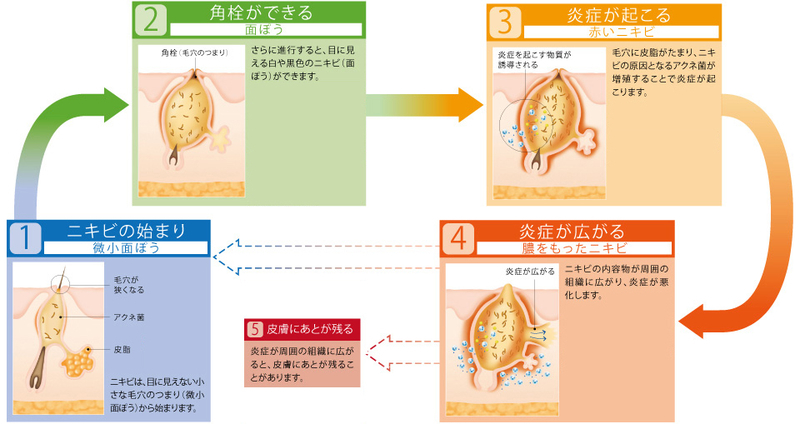 ニキビのメカニズム