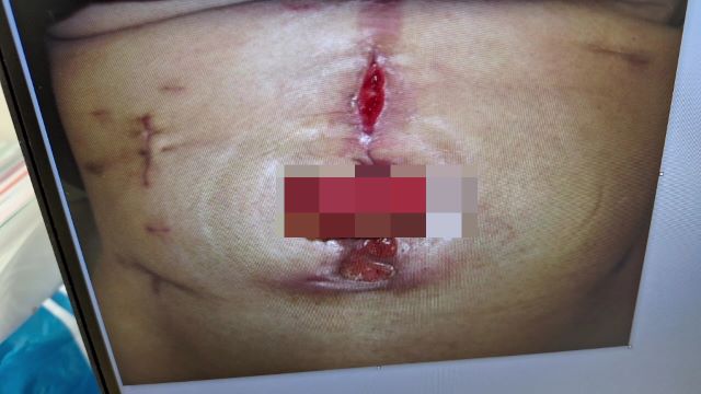 人工肛門閉鎖術後の後遺症について…退院して自宅療養に入っています【介護日記】