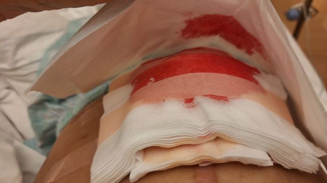 人工肛門閉鎖術の後遺症について…退院して自宅療養に入っています【介護日記】