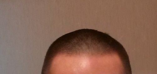 画像付き バリカンで髪型を坊主頭にした感想とメリット 注意点 丸刈り ノーワーク ベストライフ
