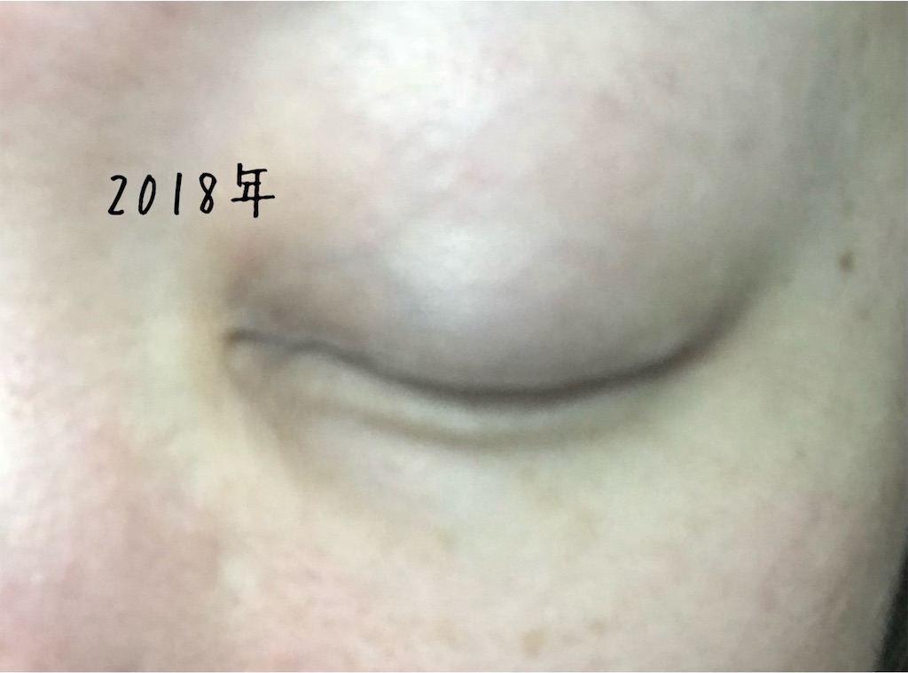 まつげ全部抜いたらこうなります 抜毛症の人は自分のストレスに気づいて まつげが無い人のブログ