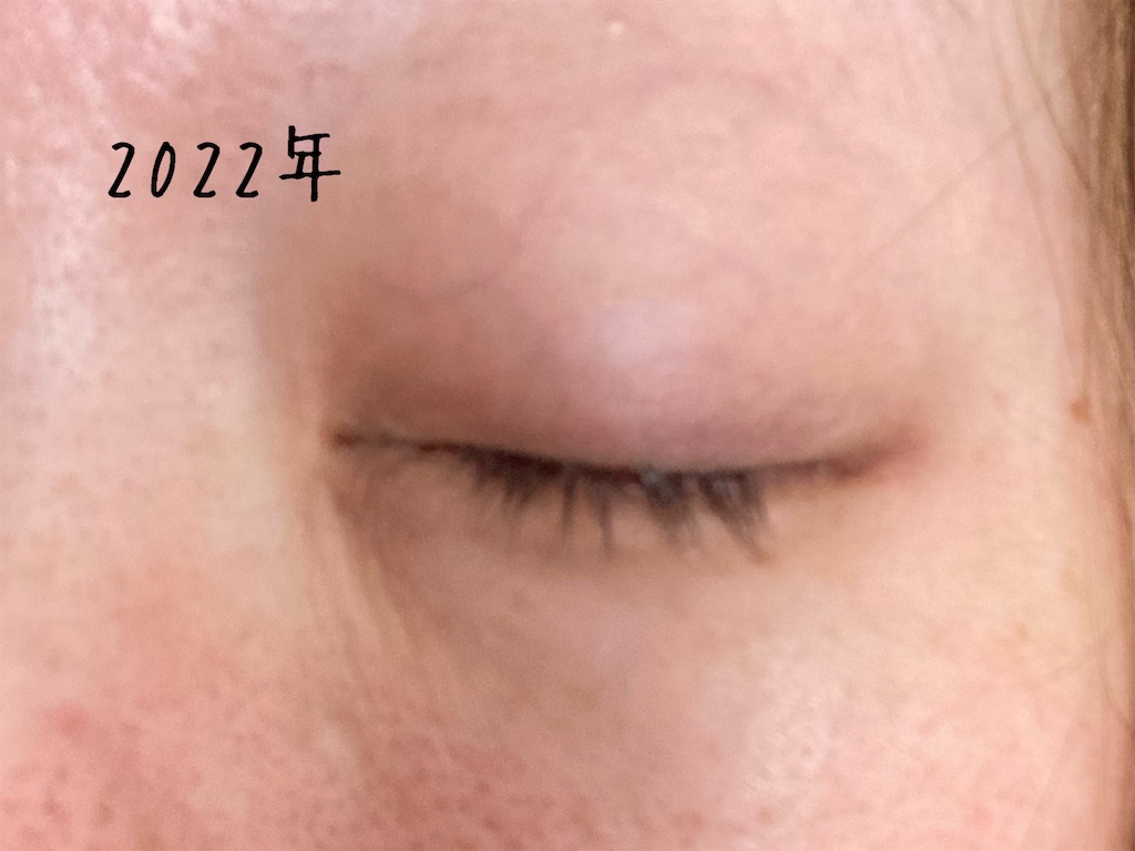 睫毛は抜いても生えてきます！抜毛症、まつ毛を抜く癖 まつげが無い人のブログ