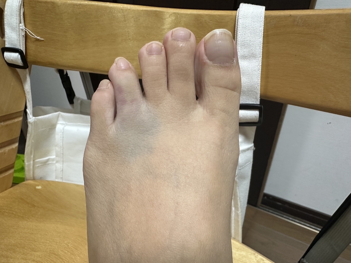 足の薬指をぶつけて骨折した状態（青あざ）