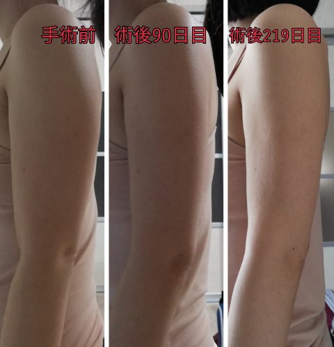 めぐの二の腕の脂肪吸引ブログ 手術前からダウンタイムまで