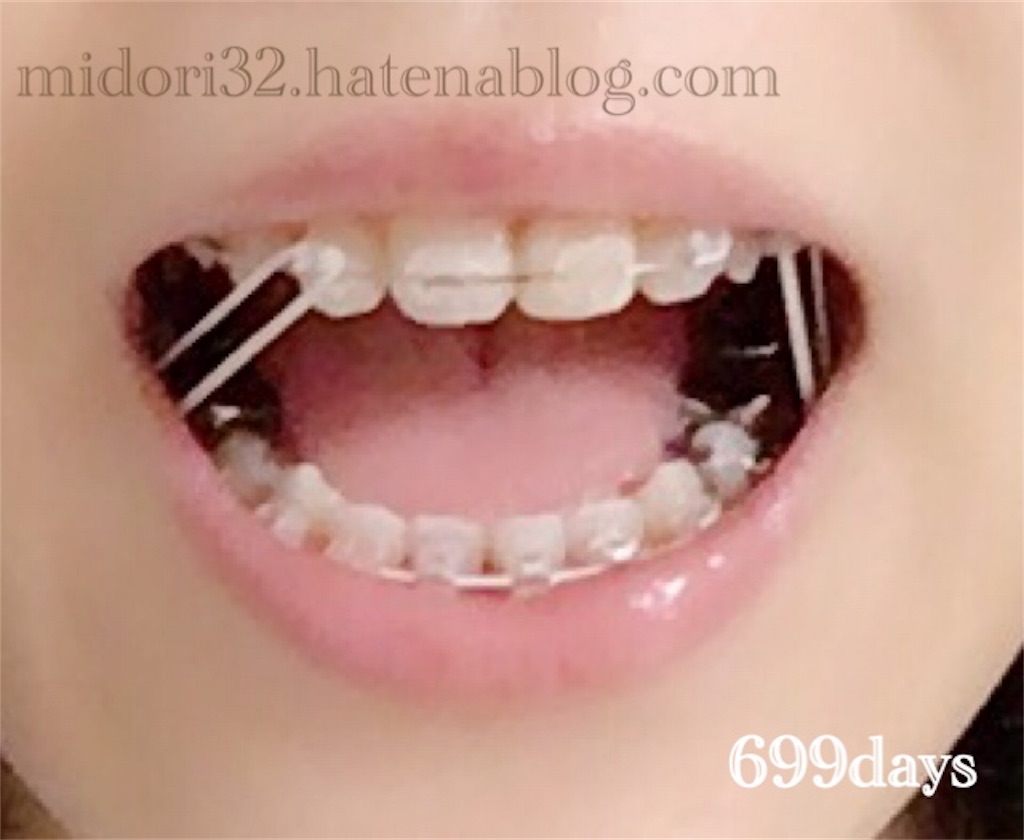 大人の歯列矯正699日目 顎間ゴムは続くよどこまでも よりどりみどり