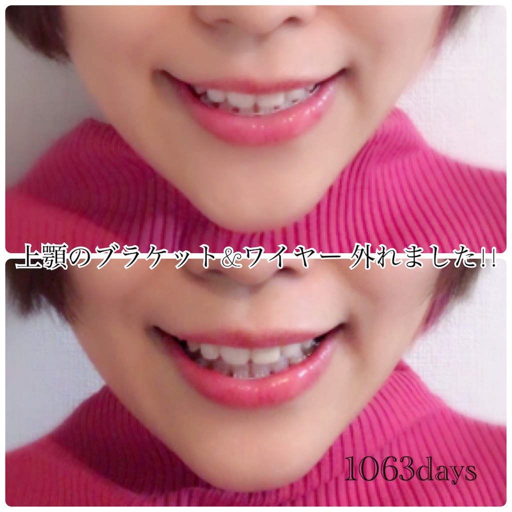 大人の歯列矯正1063日 おめでとう 上顎の矯正装置が除去 保定装置と少々の難 よりどりみどり