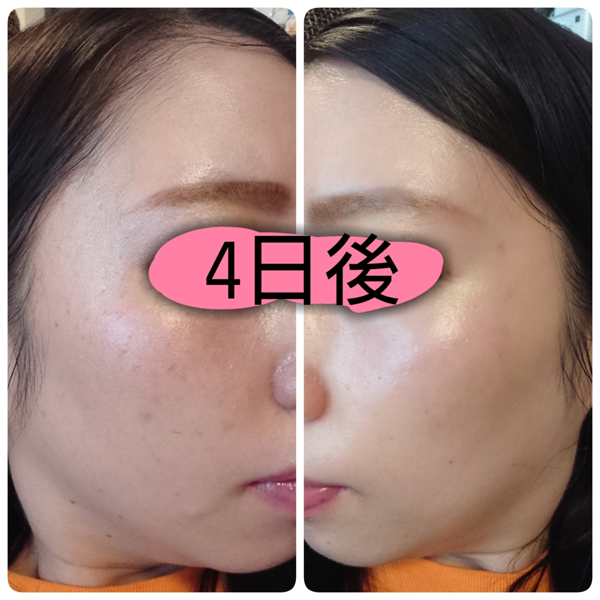 低周波ペンシルでシミ除去（8）】照射7回目☆DTはきついけどまぁ耐え