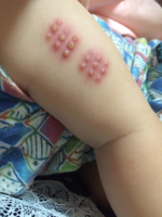 画像注意 g１カ月後の腫れと膿がグロ怖すぎる 時短勤務で働くママ Vs 3人育児とちょいぽちゃ旦那