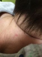 子どものあざは遺伝？生まれつき顔にあざがある息子〜治療と考え方 