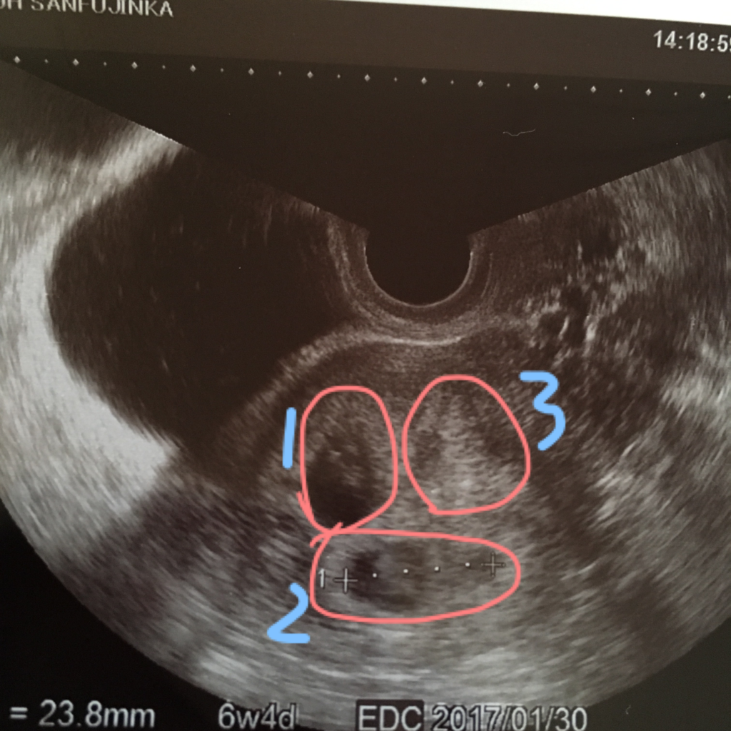 妊娠発覚までのあれこれ Triplets みつごとくらす