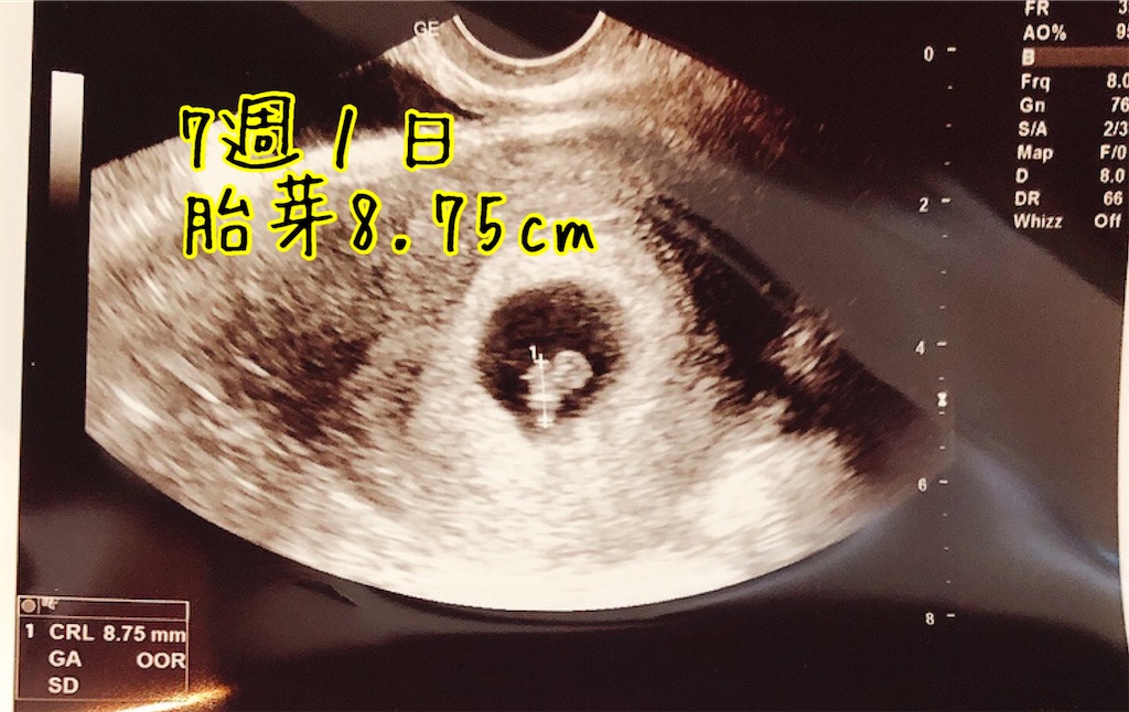7週1日 心拍確認 Rct採卵9回 モザイク妊娠7か月 現在45歳
