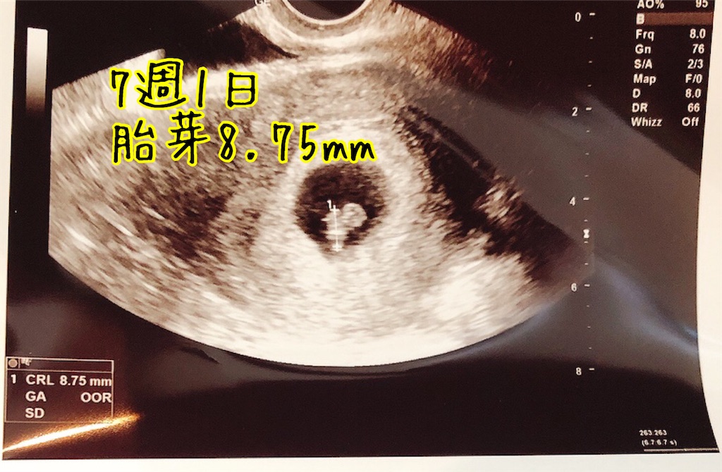 7週1日 心拍確認 Rct採卵9回 モザイク妊娠7か月 現在45歳