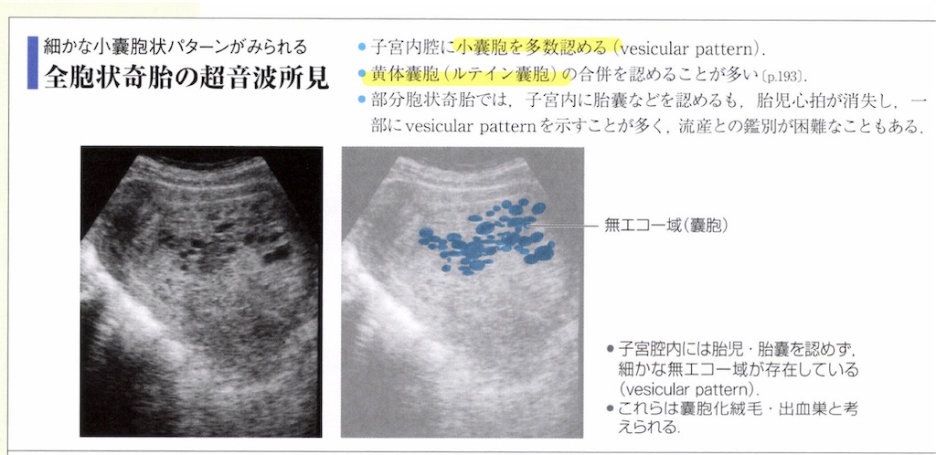 全 胞状 奇 胎