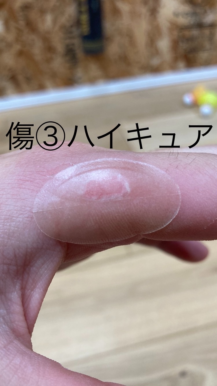 野球マメの最速治療4選 野球好き薬剤師がハイドロコロイド製剤を使ってみた 岡崎市周辺で野球がやりたくなるブログ 野球マメの最速治療4選 野球好き薬剤師がハイドロコロイド製剤を使ってみた 岡崎市周辺で野球がやりたくなるブログ